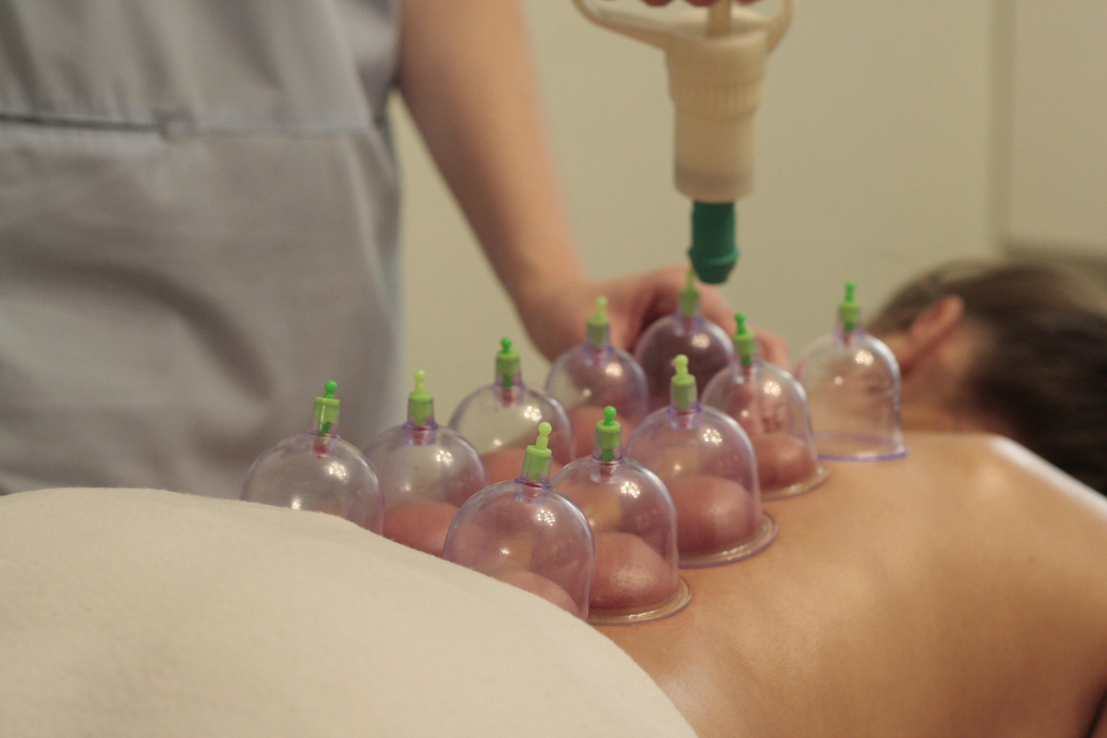 Ventouses de cupping posées sur le dos d'un patient